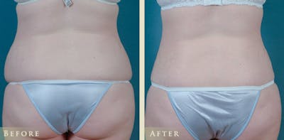 Tummy Tuck Before & After Gallery - Patient 373403 - Image 4