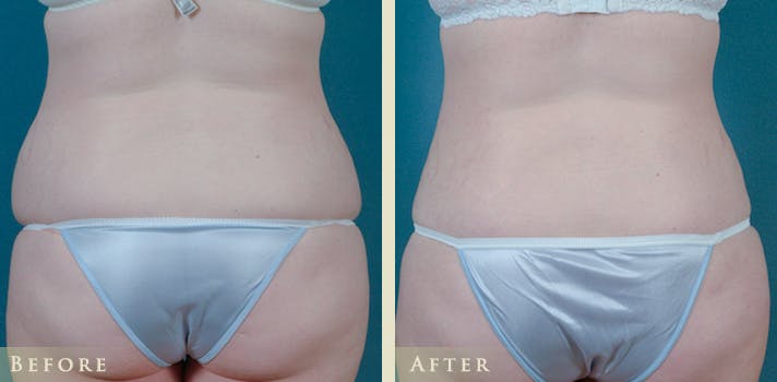 Tummy Tuck Before & After Gallery - Patient 373403 - Image 4