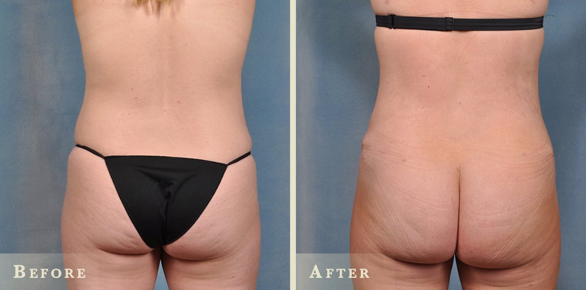 Brazilian Butt Lift Before & After Gallery - Patient 319856 - Image 1