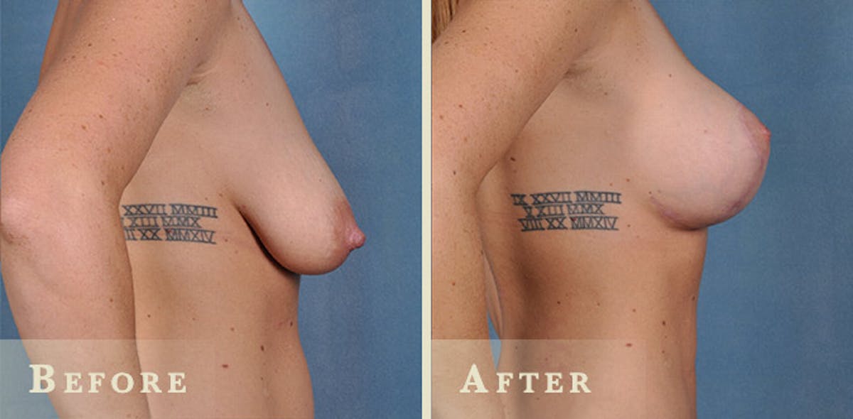 Breast Augmentation with Saline Implants Before & After Gallery - Patient 354149 - Image 3