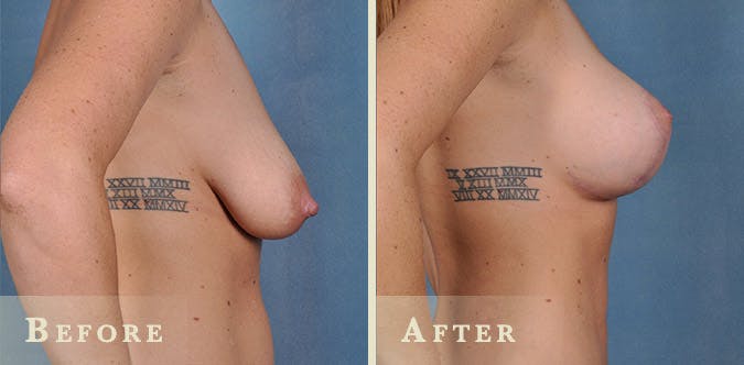 Breast Augmentation Before & After Gallery - Patient 407223 - Image 3