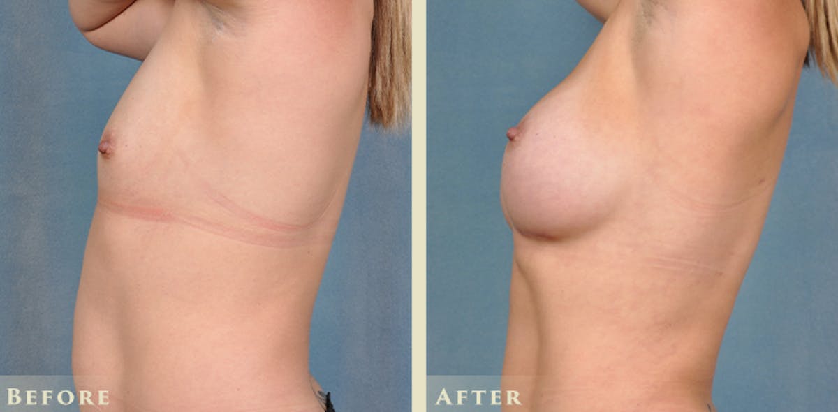 Breast Augmentation with Silicone Implants Before & After Gallery - Patient 420704 - Image 3