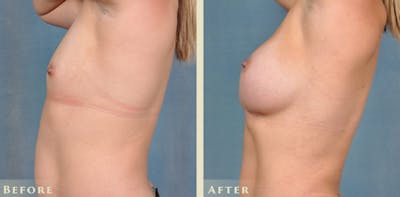Breast Augmentation Before & After Gallery - Patient 420704 - Image 3