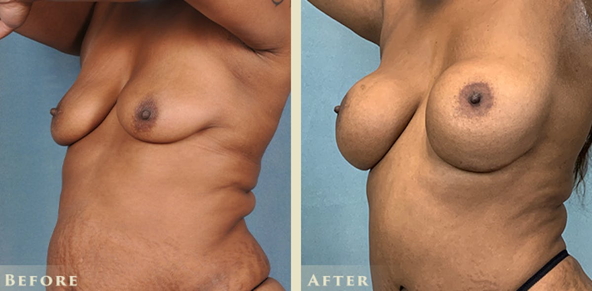 Breast Augmentation and Lift  Before & After Gallery - Patient 302480 - Image 2