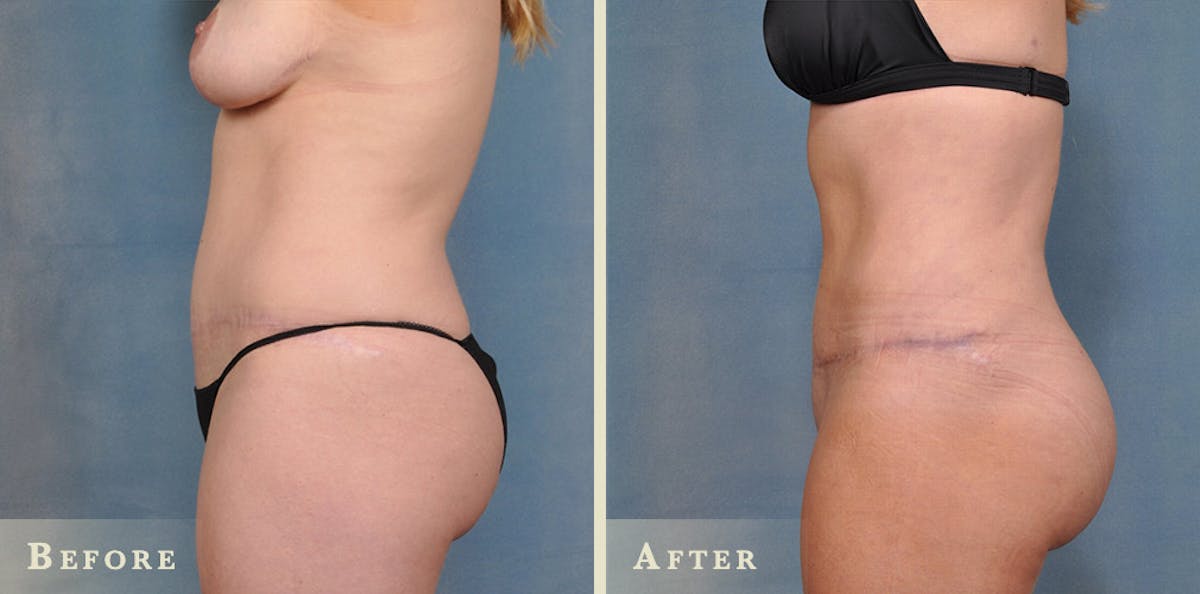 Brazilian Butt Lift Before & After Gallery - Patient 319856 - Image 2