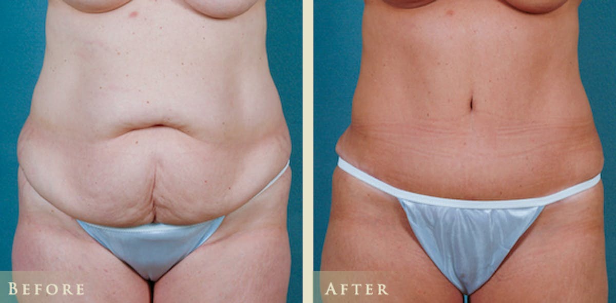 Tummy Tuck Before & After Gallery - Patient 179031 - Image 1