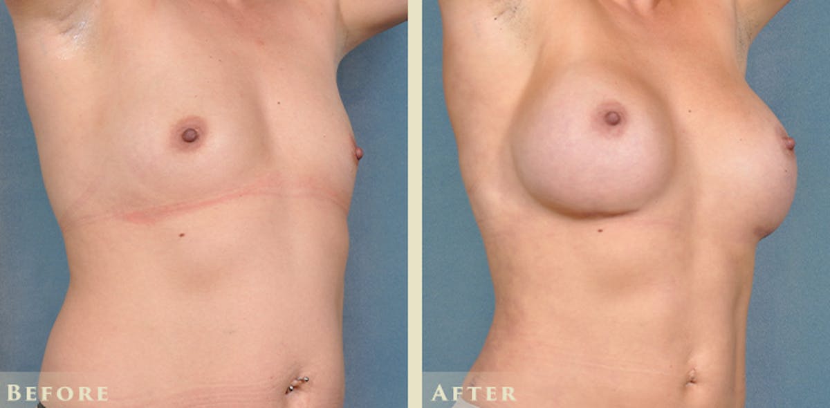 Breast Augmentation with Silicone Implants Before & After Gallery - Patient 420704 - Image 4
