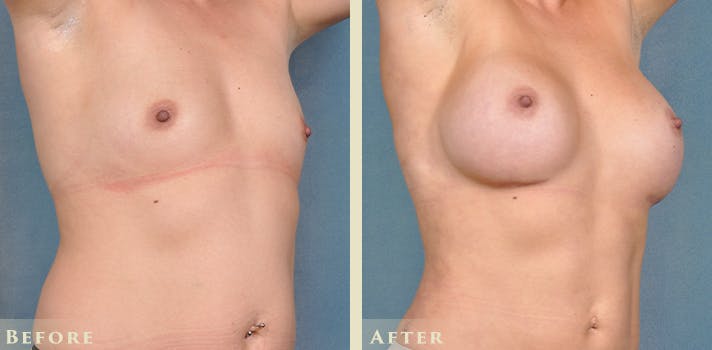 Breast Augmentation Before & After Gallery - Patient 420704 - Image 4