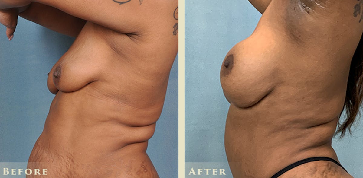Breast Augmentation and Lift  Before & After Gallery - Patient 302480 - Image 3