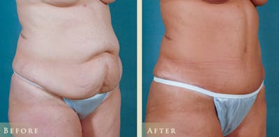Tummy Tuck Before & After Gallery - Patient 179031 - Image 2