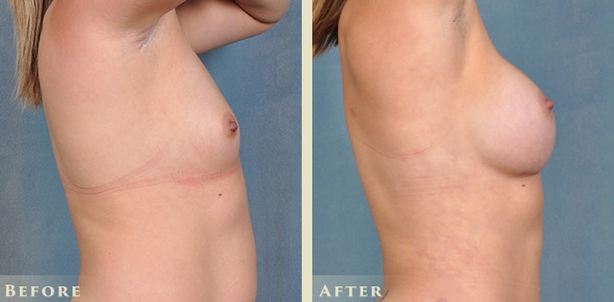 Breast Augmentation with Silicone Implants Before & After Gallery - Patient 420704 - Image 5