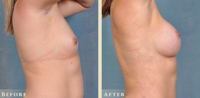 Breast Augmentation Before & After Gallery - Patient 420704 - Image 5