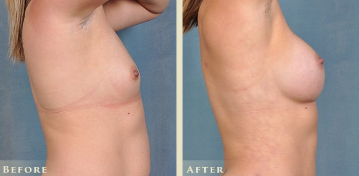 Breast Augmentation Before & After Gallery - Patient 420704 - Image 5