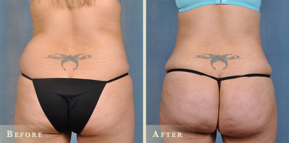 Brazilian Butt Lift Before & After Gallery - Patient 400503 - Image 1