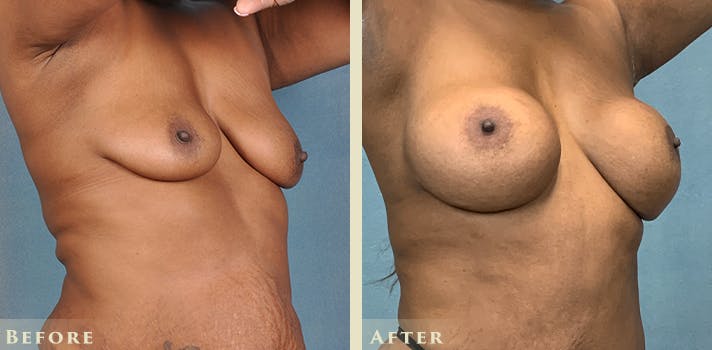 Breast Augmentation and Lift  Before & After Gallery - Patient 302480 - Image 4