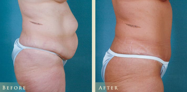 Tummy Tuck Before & After Gallery - Patient 179031 - Image 3