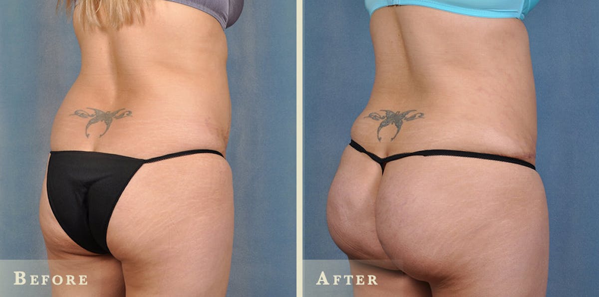 Brazilian Butt Lift Before & After Gallery - Patient 400503 - Image 2