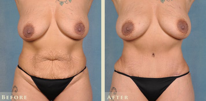 Female Liposuction Before & After Gallery - Patient 413551 - Image 1