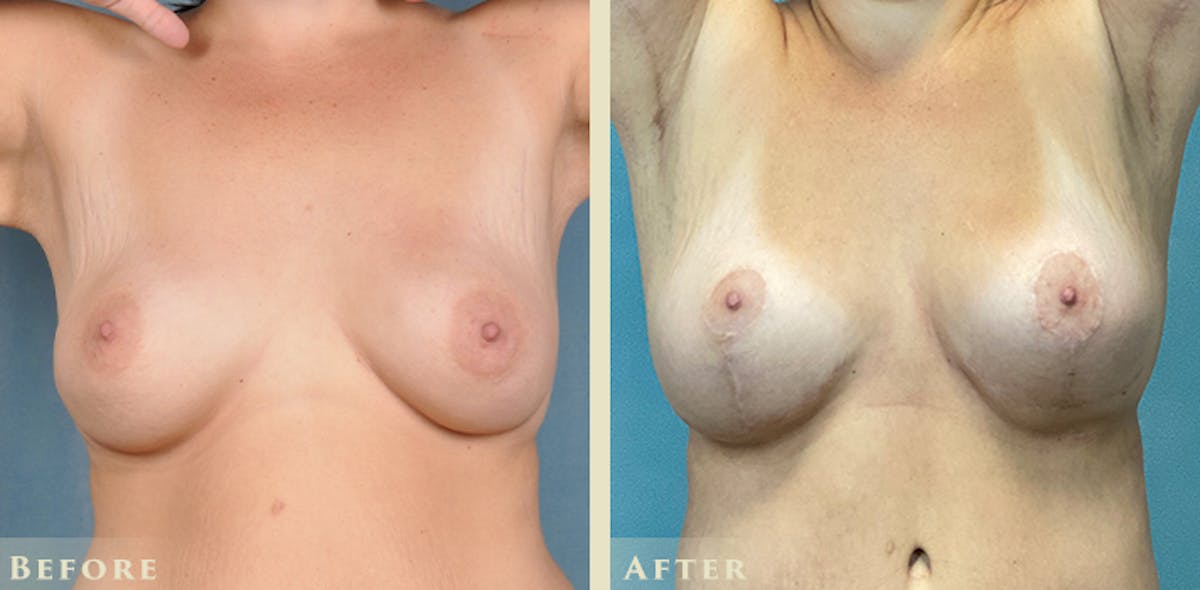 Explant with Lift Before & After Gallery - Patient 232665 - Image 1