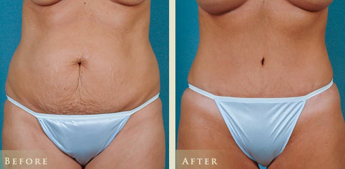 Tummy Tuck Before & After Gallery - Patient 352203 - Image 1