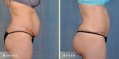 Brazilian Butt Lift Before & After Gallery - Patient 400503 - Image 3