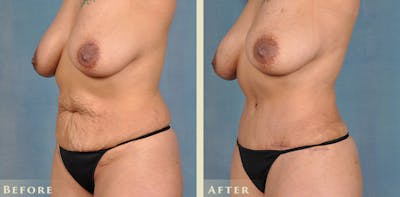 Female Liposuction Before & After Gallery - Patient 413551 - Image 2