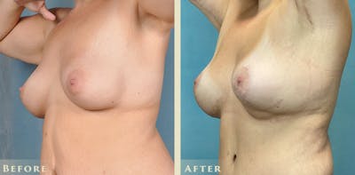 Explant with Lift Before & After Gallery - Patient 413618 - Image 2