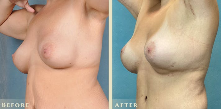 Explant with Lift Before & After Gallery - Patient 413618 - Image 2