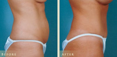 Tummy Tuck Before & After Gallery - Patient 352203 - Image 2