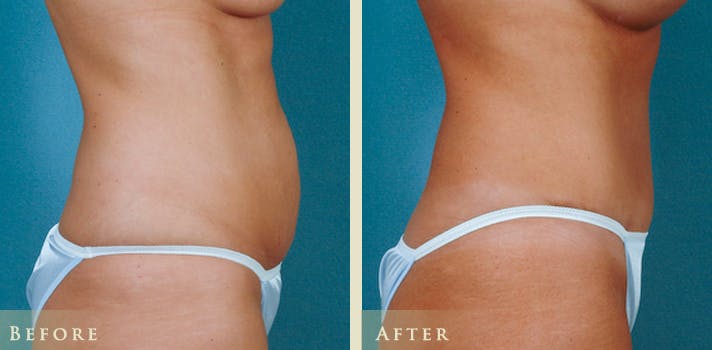Tummy Tuck Before & After Gallery - Patient 352203 - Image 2