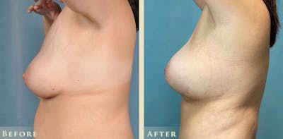 Explant with Lift Before & After Gallery - Patient 413618 - Image 3