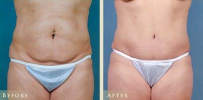 Tummy Tuck Before & After Gallery - Patient 324242 - Image 1