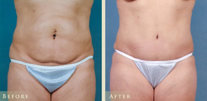 Tummy Tuck Before & After Gallery - Patient 324242 - Image 1