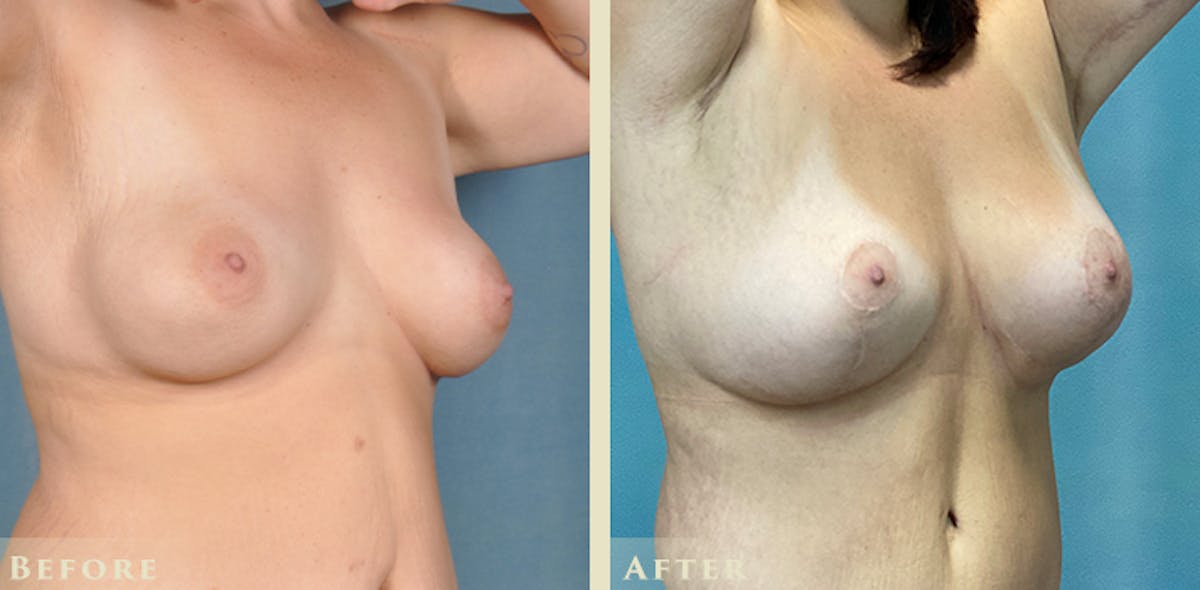 Explant with Lift Before & After Gallery - Patient 232665 - Image 4