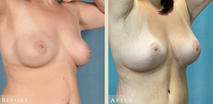 Explant with Lift Before & After Gallery - Patient 413618 - Image 4