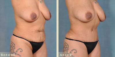Female Liposuction Before & After Gallery - Patient 413551 - Image 4
