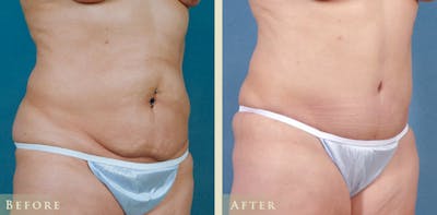 Tummy Tuck Before & After Gallery - Patient 324242 - Image 2