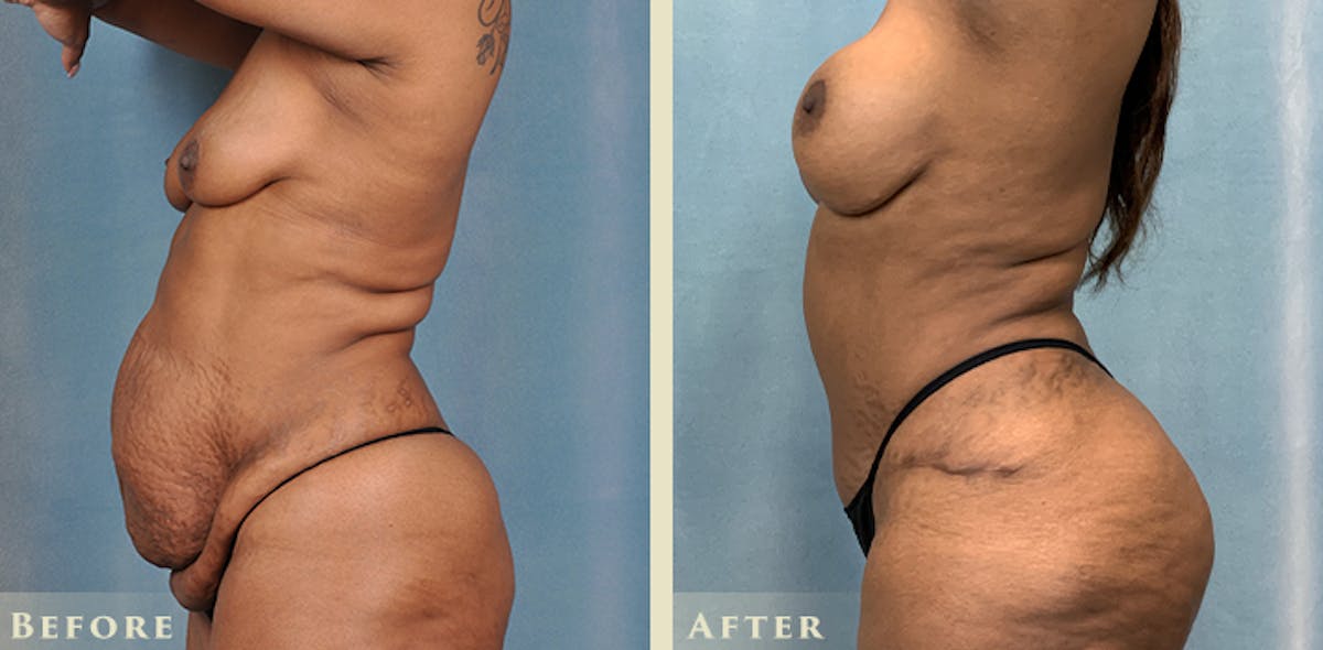 Brazilian Butt Lift Before & After Gallery - Patient 823118 - Image 3