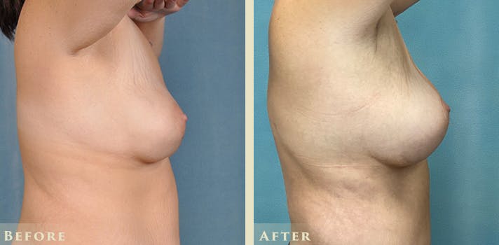 Explant with Lift Before & After Gallery - Patient 413618 - Image 5