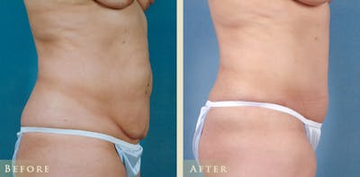 Tummy Tuck Before & After Gallery - Patient 324242 - Image 3