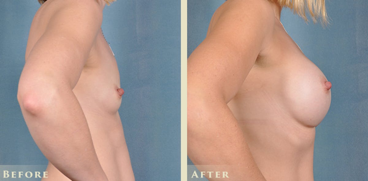 Breast Augmentation with Silicone Implants Before & After Gallery - Patient 217782 - Image 6