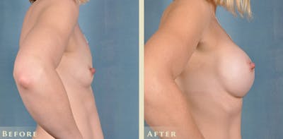Breast Augmentation Before & After Gallery - Patient 217782 - Image 6