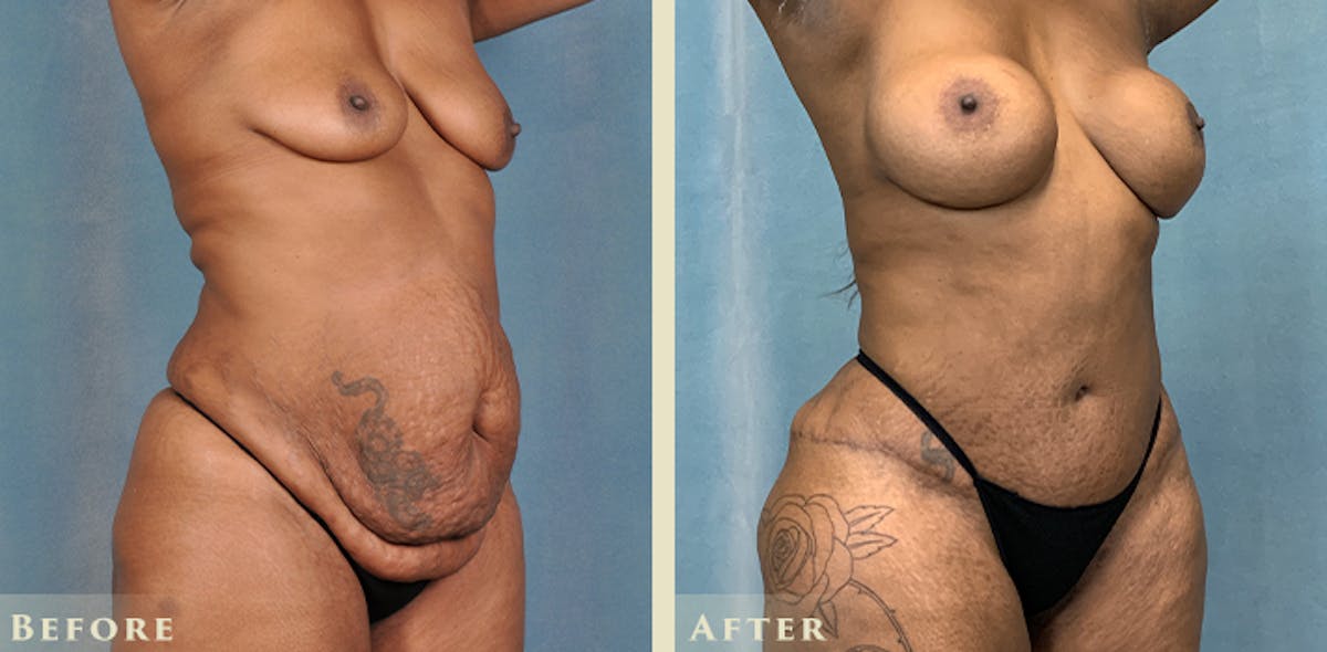 Brazilian Butt Lift Before & After Gallery - Patient 823118 - Image 4