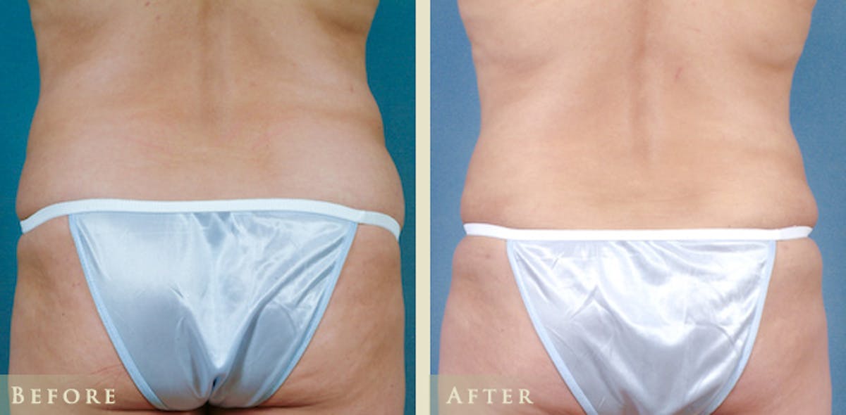 Tummy Tuck Before & After Gallery - Patient 324242 - Image 4
