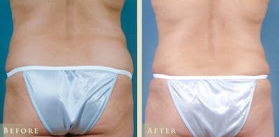 Tummy Tuck Before & After Gallery - Patient 324242 - Image 4