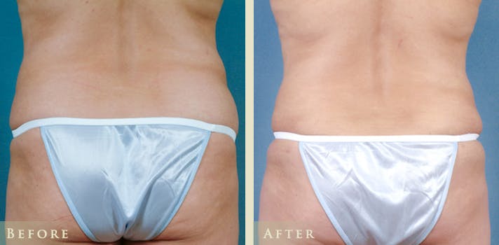 Tummy Tuck Before & After Gallery - Patient 324242 - Image 4