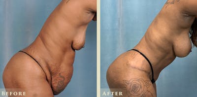 Brazilian Butt Lift Before & After Gallery - Patient 823118 - Image 5