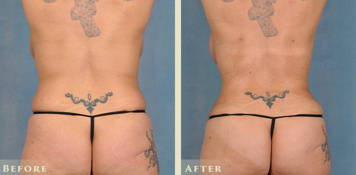 Female Liposuction Before & After Gallery - Patient 413551 - Image 7