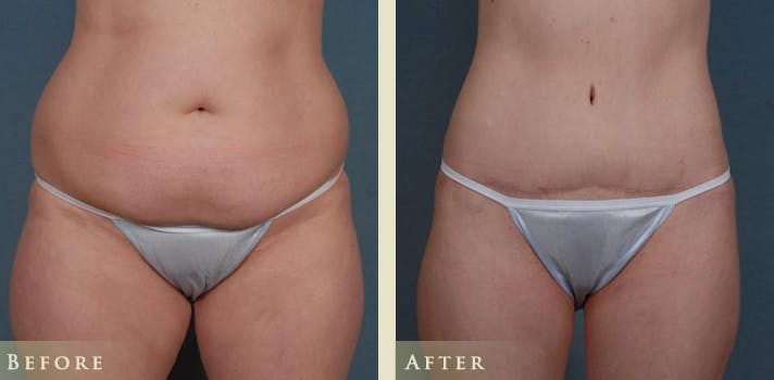 Tummy Tuck Before & After Gallery - Patient 137691 - Image 1