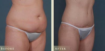 Tummy Tuck Before & After Gallery - Patient 137691 - Image 2